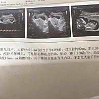 昨天12周，nt通过了，有谁会看男女的吗？