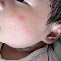 有宝妈知道这是怎么回事吗？ 不知道是不是宝宝过敏了吗？