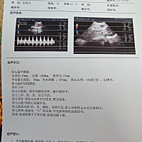 脐带绕颈一周  有会看的宝妈吗？