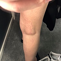 怀孕期间长的 现在生完了 会消下去吗