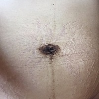 那么大个肚子，生了双胞胎付出的代价，这肚子上的妊娠纹 再也消不掉了，黑色的那些会不会淡化？😭😭