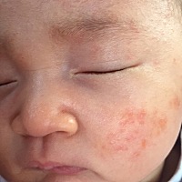 宝宝脸上有湿疹，用了婴宝不管用，求各位宝妈支招