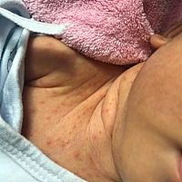 各位宝妈们 请问下我家宝宝脖子上长了这些小颗粒是什么？怎么治疗