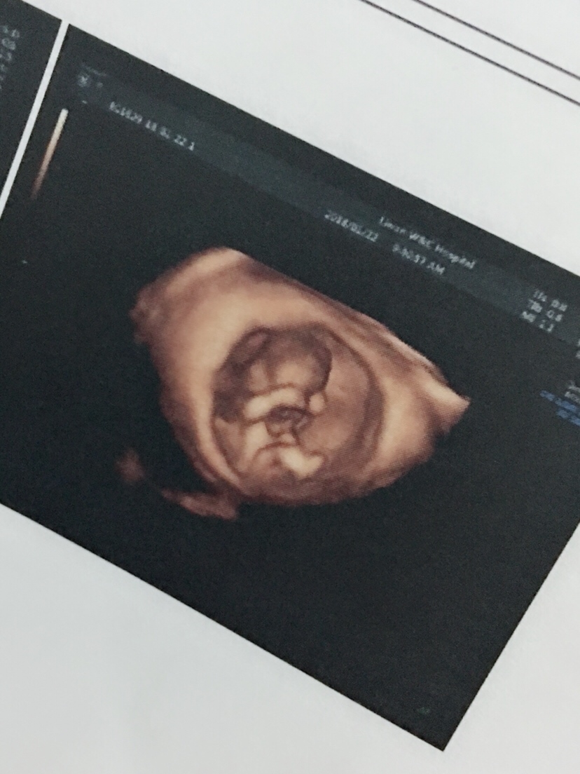 一胎时忌口。二胎不忌口～出生后比姐姐还白😄