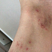 明天满月了，最近身体发痒，越抓越痒，抓破皮了就烂，反复发作。是不是得了皮肤病。