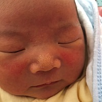 请问下有人知道宝宝脸上和鼻子上是怎么回事吗？