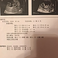 NT顺利通过，医生说双胎不能做唐筛，只能羊穿或者无创，选择最保险的无创。12周还是有点恶心没胃口，不...