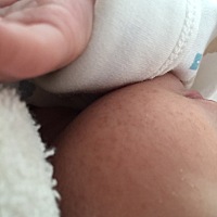 宝宝生出来两边脸蛋有黑色斑点，有知道这是什么的吗，是黑色素吗，会不会消失啊，急