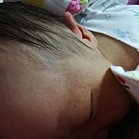 脸上长痘痘了怎么办？