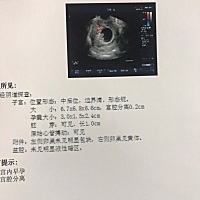 怀孕52天 查出来宫腔分离 宝妈们有知道的吗 这个情况严重吗