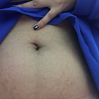 请问这是怀孕的妊娠纹还是胖的？，，本人130斤