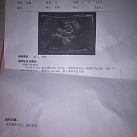17周期检查的唐塞，这个单子写的什么意思，胎儿好不好啊，求告知