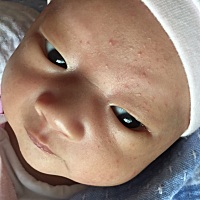 请问大家，宝宝脸上长了好多小红痘痘，是怎么回事，