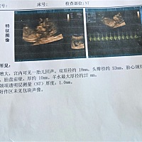 今天去做了NT，医生说没问题，宝妈们帮我看看，谢谢😜