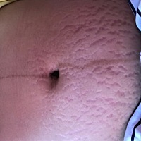 生完宝宝的第6天。肚子都毁了。😭