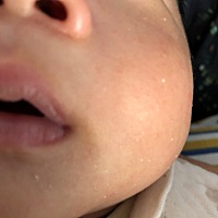 脸上这个是什么 生出来就有 后期会没有吗？