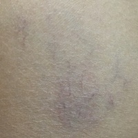 整个孕期腿上到处都在长这种纹路[撇嘴] 万能的孕圈 有谁知道这是什么呀？🙏