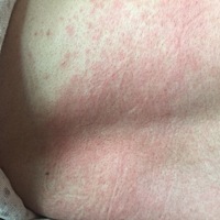 我产后1周，全身长红疹发痒，还能喂奶吗？这是什么情况，不吃药能好吗？