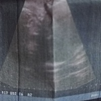有谁看得懂B超图这是怎么说男宝还是女宝