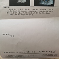 NT顺利通过，超级开心，晒下B超单子，能看出男女吗，纯属好奇→_→
