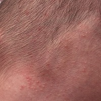 刚满月，宝宝头上这是啥了？这两天更多了