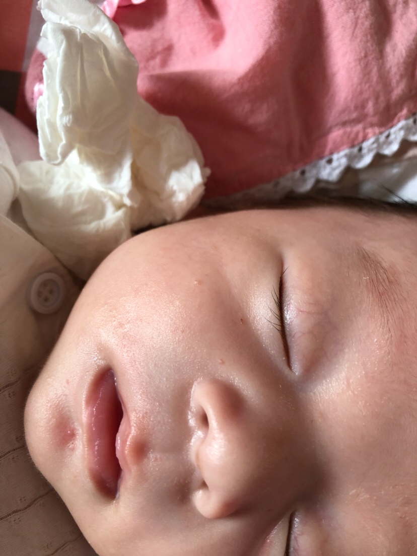 看看我家宝宝脸上起的那是什么？