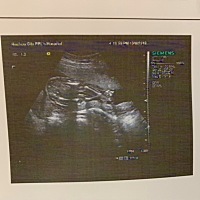 大神帮来看一下是男孩女孩 听说这是腿，中间是蛋蛋，有没有人看得懂？