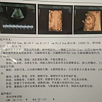 22周，胎盘1级是不是不正常？是不是钙补过了？