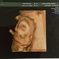 今天做四维问医生是女孩吗？我说我抛妇产就生两个了。医生说还没看到，隔了两分钟医生却唉声叹气，整个...