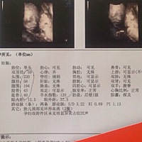 四维一次通过，所有的担心都变成安心啦，刚开始趴着医生敲打几下翻过来啦😄！希望大家接好运！大家猜...