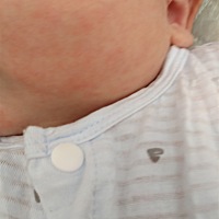 请问宝宝脸上长的红疙瘩是什么 要紧吗