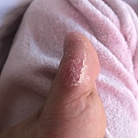 月子期间，脚指头原来有脚气的地方裂了，怎么办啊