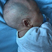 宝妈们，有没有宝宝长过痤疮的，自从满月剃头师傅剃了头就这样了，怀疑是剃头刀没消毒，宝宝过敏了，去...