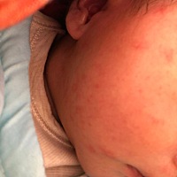 宝宝这两天脸上总出红疙瘩，时好时坏，今天下去，明天其他地方就出来啦，这个到底有事没，新妈妈上路，...