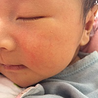 宝妈们，这是湿疹吗？需要用什么药吗？