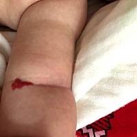 宝宝得了血管瘤怎么办