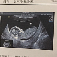 12周+ 能看出男孩女孩吗？