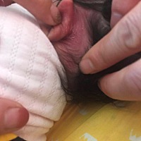 有没有宝妈和我家宝宝一样状况的 生下来耳朵后面就有一片红 一按就变肤色 听网上说应该是鲜红斑痣 有没...