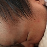 有哪位宝妈知道这是什么  只有脸上有