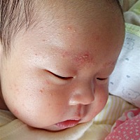 请问孩子脸上这是啥？身上没有就脸上有，用什么药啊？