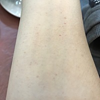 急急急 各位生完孩子的宝妈有没有跟我一样状况的 右手臂上长了很多这样的小红点 不痛也不痒 左手臂没有