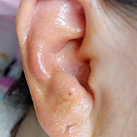 做月子第十七天！耳朵肿成这样是不是得了创耳风啊？就右边头是疼的，右边牙肉喉咙舌头是烂了的！去医院...