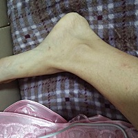 各位孕妈有没有一样的问题啊。就是怀孕了以后会长红色的小痘痘😭😭😭