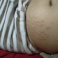 六个多月了，这个纹路太多了，一直擦着橄榄油都不管用，烦死了！就怕后期更多！最近几天两边屁股蹲里边...