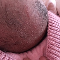 亲爱的宝妈们有谁知道？我女儿头上长的这些是什么，怎么样才能好，