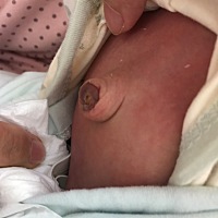 儿子出生15天了，脐带刚掉，肚脐有点凸出？医生说过段时间会长进去，有遇到过的没有？