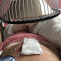 三胎都是刨腹产，喜得我的小公主，儿女双全了，虽然过程无法忍受，现在已经恢复不错，一切都是值得了，...