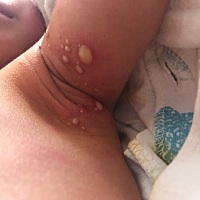 急急急，刚出生5天宝宝腋下长脓包，越来越大，准备下午去医院，有宝妈知道怎么回事吗？好着急