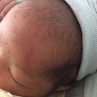 今天宝宝身上长了好多这样的痘痘。 医生说的吓人的很  让进保温箱。然后他们有点人又说不怎么样 有没有...