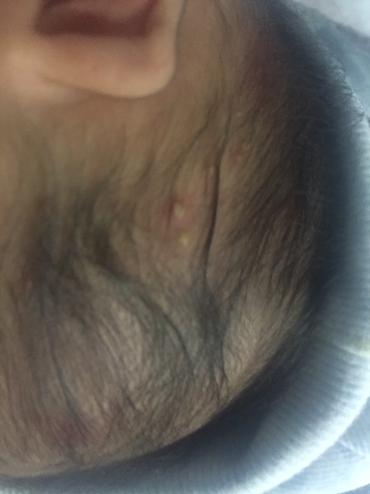 怎么办 身上和头上长了好多种痘痘。